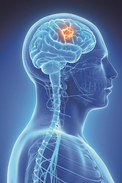 Tumortherapiefelder sind rasch wechselnde elektrische Felder. Sie können die Teilung der Tumorzellen verlangsamen oder stoppen und zu ihrem Absterben führen. © Sebastian Kaulitzki - stock.adobe.com TRD / Medical Press